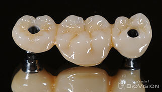 Screw Retained Monolithic Zirconia Br