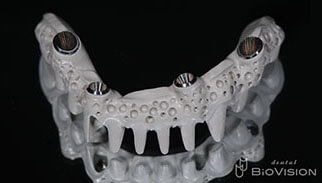 Pekkton Substructure with Pink Hybrid Resin & Individual Press Crowns