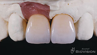 Layered Zirconia Ceramic Cr & Screw Retained Zirconia Ceramic