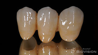 Full Anatomic Zirconia Br