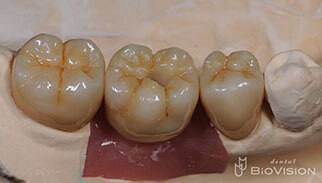 Full Anatomic Zirconia Crowns & Screw Retained Full Zirconia