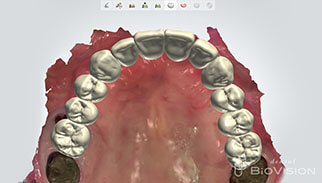 Diagnostic by Digital Design & Milled PMMA Resin up