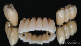 3segments Screw Retained Monolithic Zirconia Bridge