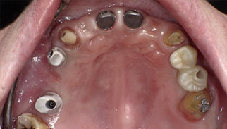 Zirconia Prosthesis with Full Digital Design