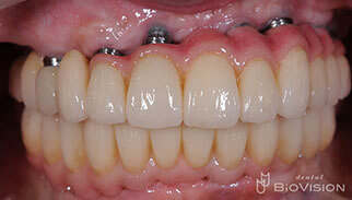 Screw Retained Zirconia Ceramic with Pink Porcelain Upper and Lower
