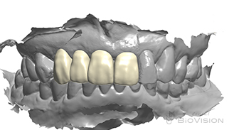 6 Front tooth screw retain superstructure and natural tooth prosthesis