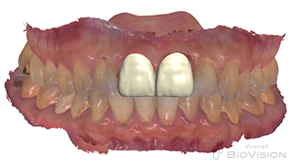 11&21 single Monolithic Zirconia Cr