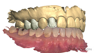 Layering Zirconia & Monolithic Zirconia