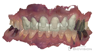 Maxillary 6 anterior teeth monolithic zirconia crown