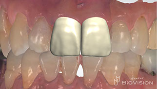 Maxillary anterior screw retain monolithic zirconia