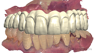 Screw Retained Full arch Monolithic Zirconia