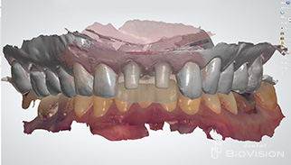 11 & 21 Pekkton Core and Monolithic Zirconia Crown