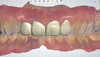 Glass-ceramic laminated veneer and monolithic zirconia crown