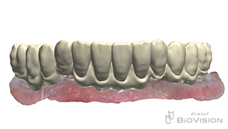 Mandibular screw retain full arch monolithic zirconia superstructure