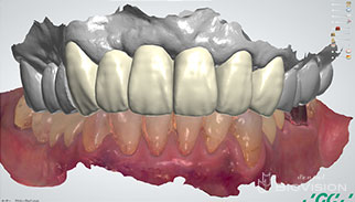 Maxillary 6 anterior teeth full zirconia bridge