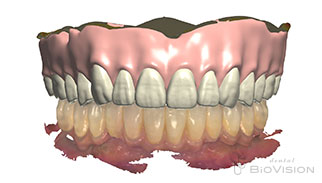 Maxillary metal plate full denture