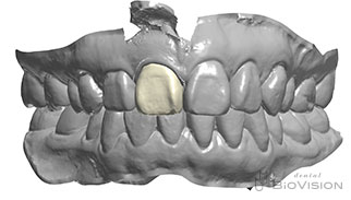 Maxillary single crown full zirconia From iTero