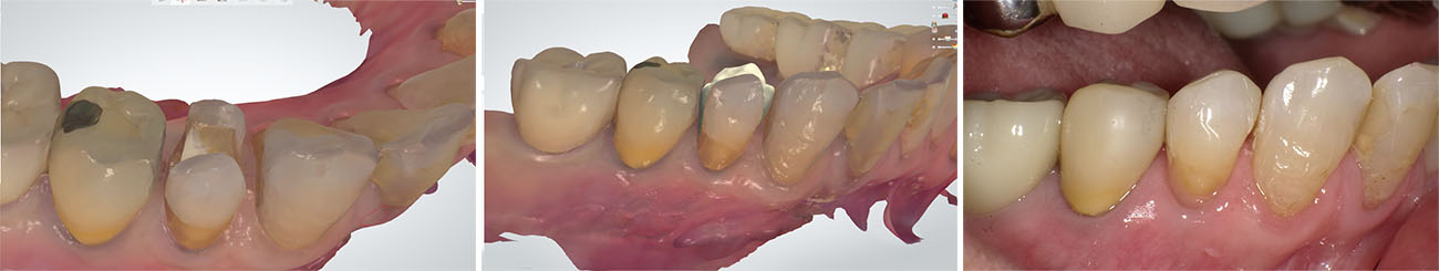 フルジルコニアインレー（口腔内スキャナー）