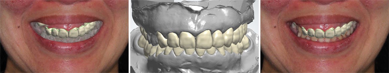 上下天然歯補綴デジタル診断