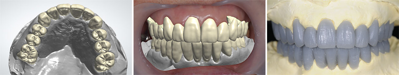 上下天然歯補綴デジタル診断＆診断用ワックスアップ
